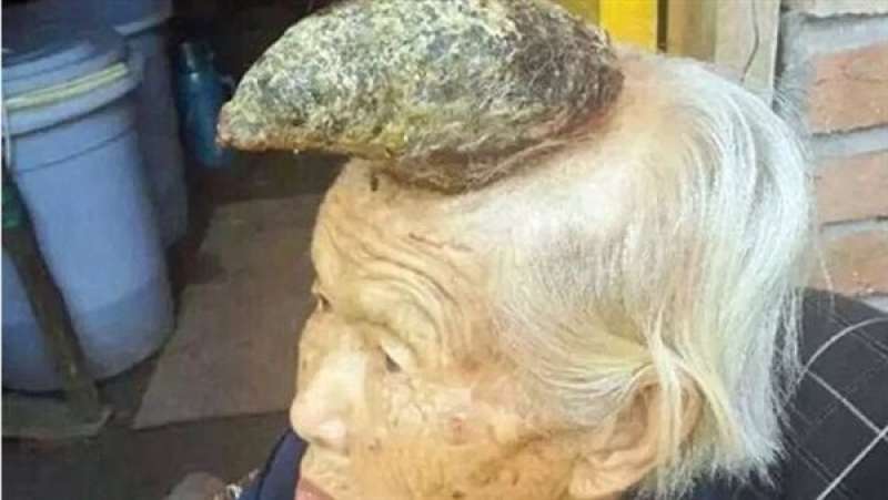 رعب قرن الشيطان.. حالات غريبة لنمو قرون في رءوس وأجساد البشر