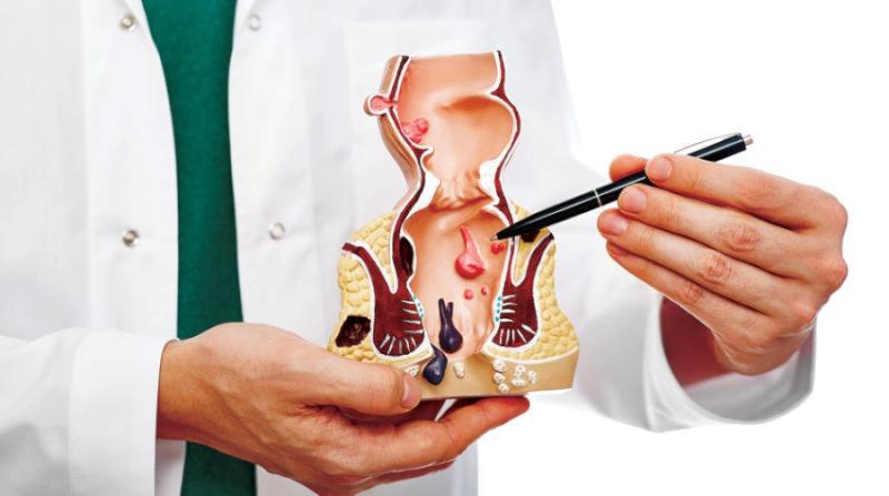 علاج البواسير في دبي: كل ما تحتاج معرفته