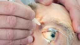 حقنة عين جديدة تعيد البصر...